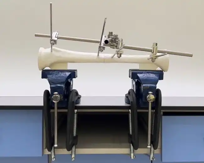 Modular External Fixation for an Open Tibial Shaft Transverse Fracture