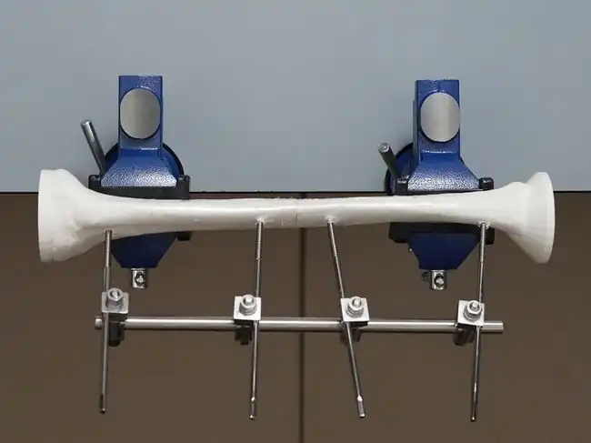 Uniplanar External Fixation for an Open Tibial Shaft Transverse Fracture