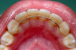 Metal Retainer