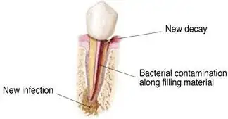 Reinfected root canal
