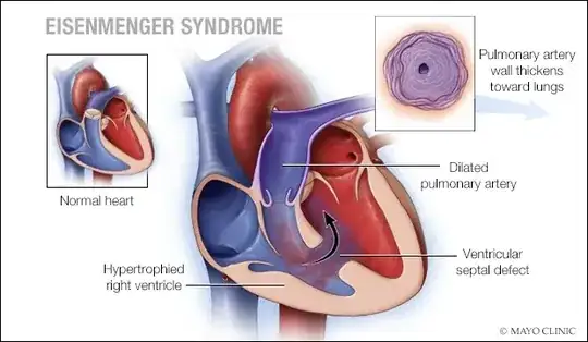 Eisenmenger’s syndrome