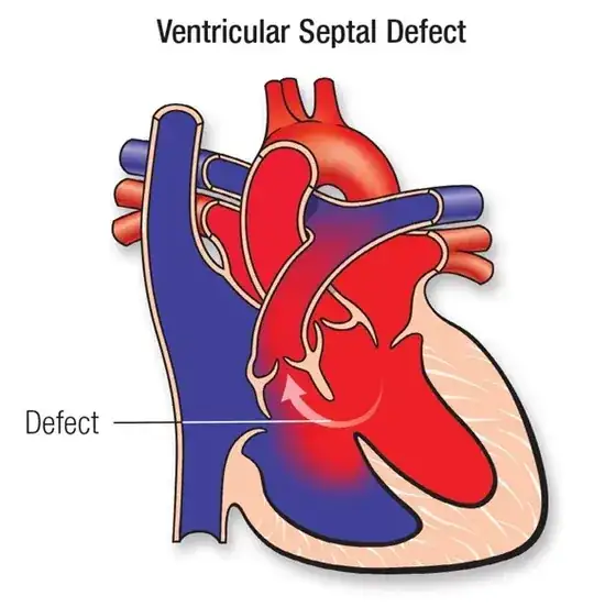 Heart and VSD