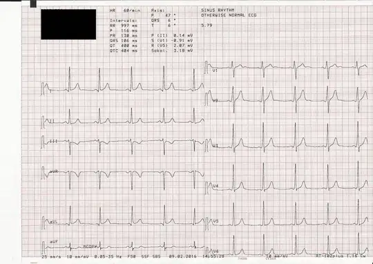 ECG