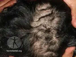 Cutis verticis gyrata