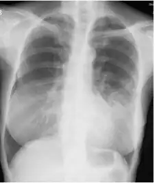 Chest radiograph