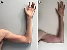 Tender, indurated, erythematous, and well-delimited linear streak from the left finger to the armpit, on the seventh day of illness. B) Aggravated lymphangitis on the ninth day of illness.
