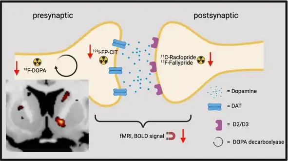 Coronar brain slice shows the reduced dopamine synthesis capacity in the right ventral striatum