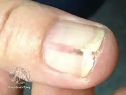 Red streak in longitudinal erythronychia