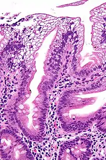 Micrograph showing enterocytes with a clear cytoplasm (due to lipid accumulation) characteristic of abetalipoproteinemia. Duodenal biopsy. H&E stain.