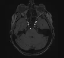 Accessory middle cerebral artery and ICA aneurysm