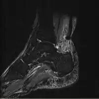 Achilles tendon rupture