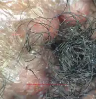 Loss of follicular ostia, tufted follicles, and papules