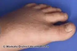 Acrokeratosis verruciformis of Hopf