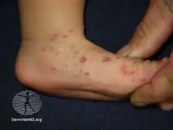 Acropustulosis of infancy