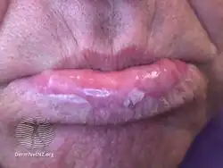 Actinic cheilitis