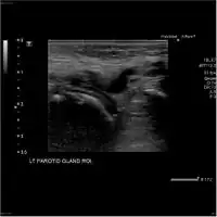 Acute left parotid sialadenitis