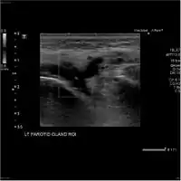 Acute left parotid sialadenitis