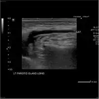 Acute left parotid sialadenitis