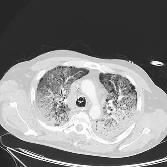 Acute respiratory distress syndrome