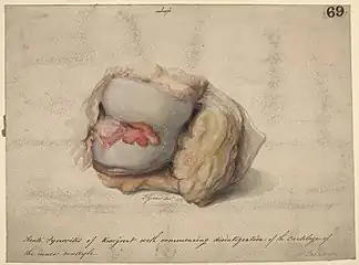 Acute synovitis of the knee joint,disintegration of the cartilage of the internal condyle