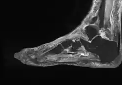 Adventitious bursitis