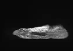 Adventitious bursitis