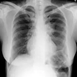 Chest X-ray:  mass overlying the left hilum