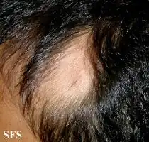 Alopecia Triangularis Congenita