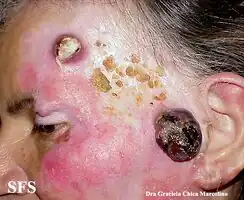 Amelanotic Lentigo Maligna And Melanoma