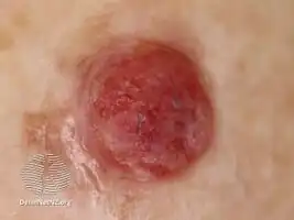 Amelanotic melanoma