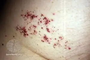 Angioma serpiginosum