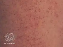 Angioma serpiginosum