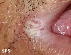 Angular cheilitis