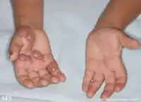 Ant bites