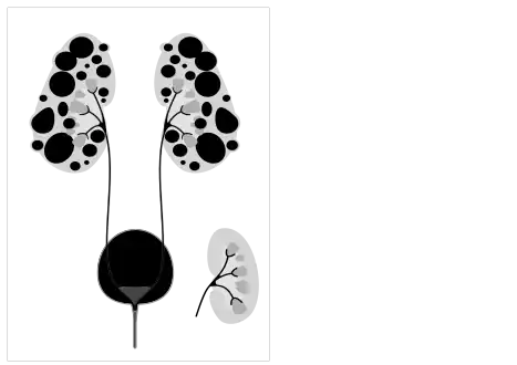 Diagram of autosomal dominant polycystic disease with a normal kidney inset for comparison