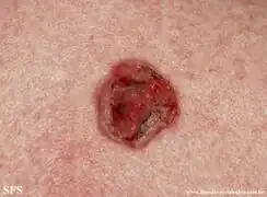 Basal-cell carcinoma