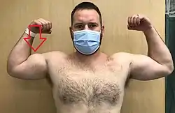 Proximal biceps tendon rupture on persons right