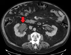 CT scan of bilateral hydronephrosis due to a bladder cancer