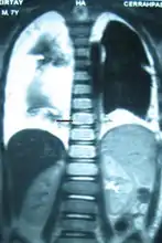 Bilateral chylothorax seen on a thoracic MRI