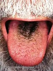 Black hairy tongue