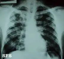 Chest X-ray