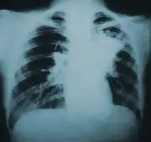 Chest X-ray