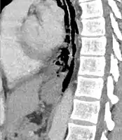 Sagittal remormatted CT image showing discontinutity in the wall of the posterolateral aspect of the distal esophagus