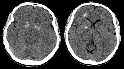 Brain CT in DiGeorge syndrome, demonstrating basal ganglia and periventricular calcification.
