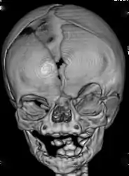 CT-scan of the skull of a person with coronal synostosis, orbital hypertelorism, and facial asymmetry as part of craniofrontonasal dysplasia.