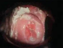 Curdy white discharge suggestive of candidiasis