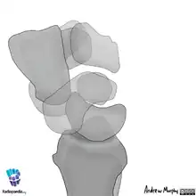 Perilunate dislocation