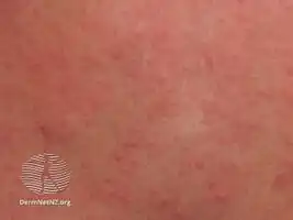 Cholinergic urticaria