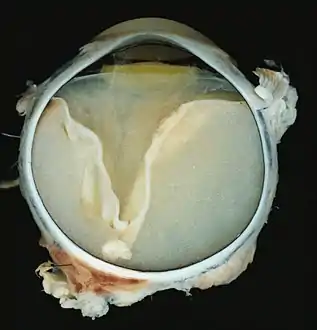 A case of Coats' disease, showing total retinal detachment with subretinal exudate containing cholesterol crystals and a fibrous nodule in the posterior pole