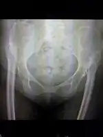 Congenital hip dislocation